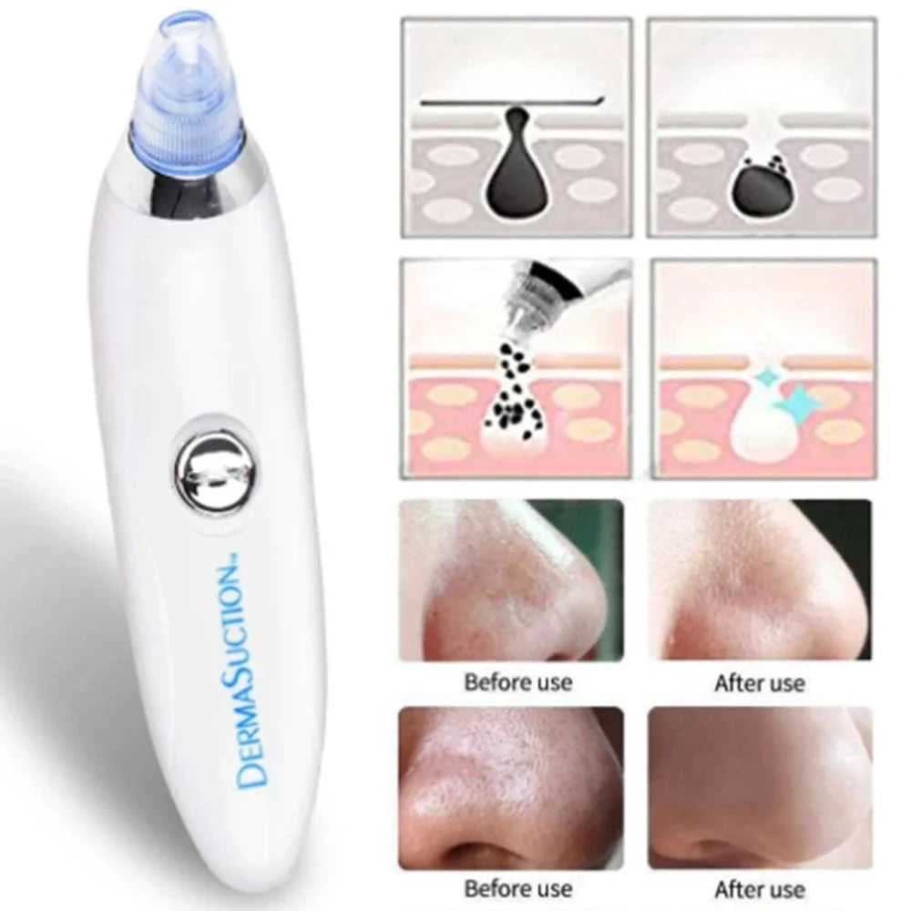 DermaSuction Pore Cleaner — product view 3